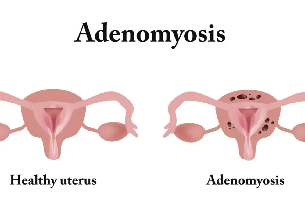 Adenomioza - bolesne miesiączki to nie zawsze endometrioza