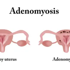 Porównanie zdrowej macicy z macicą dotkniętą **adenomiozą**, gdzie widoczne są zmiany w tkance.