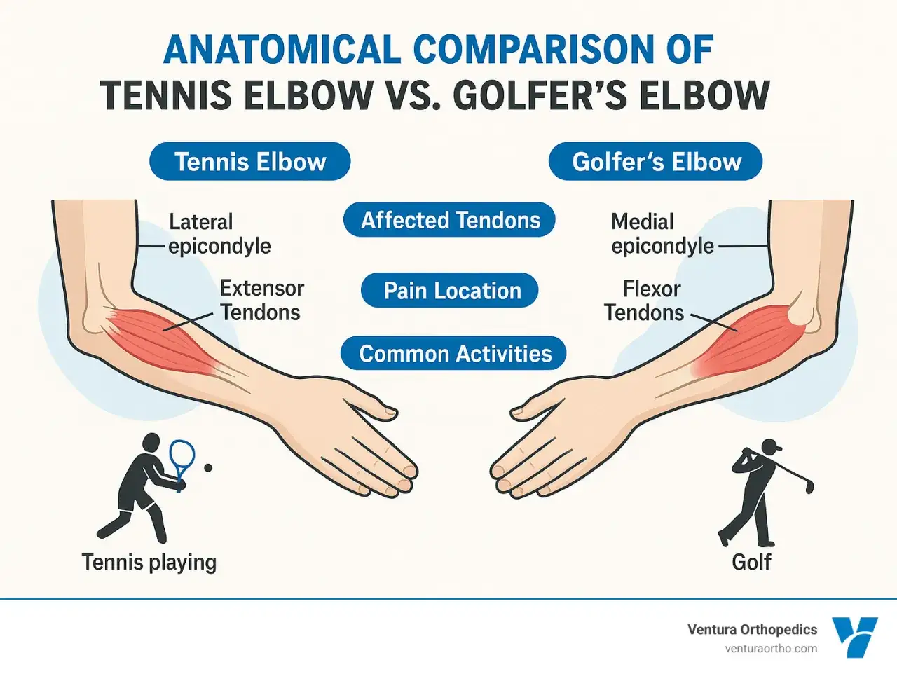 Porównanie łokcia tenisisty i łokcia golfisty. Ilustracja pokazuje anatomie obu schorzeń, lokalizację bólu i typowe czynności.