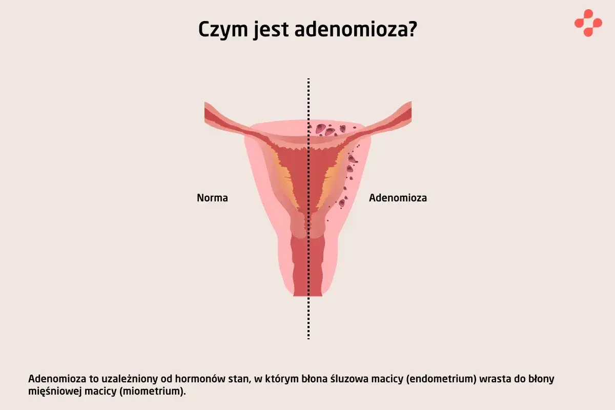 Ilustracja porównuje zdrową macicę z macicą dotkniętą adenomiozą, gdzie tkanka endometrium wrasta w mięśniówkę.