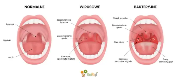 Angina bakteryjna - jak ją rozpoznać i leczyć?