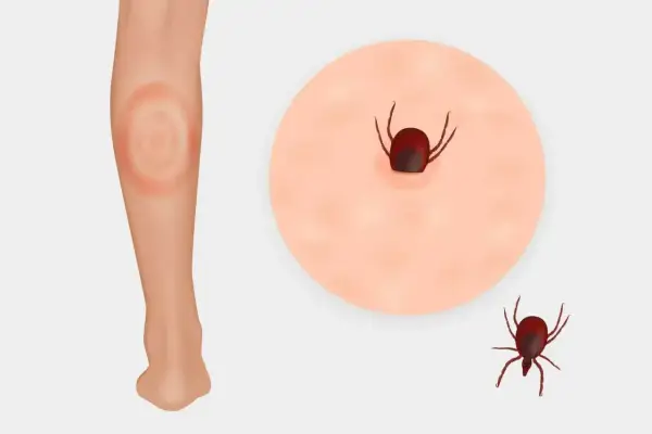 Rumień wędrujący - jak odróżnić od alergii?