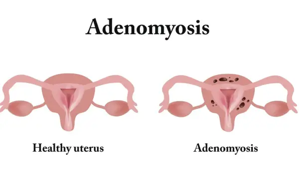 Adenomioza - bolesne miesiączki to nie zawsze endometrioza