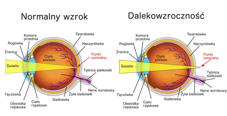Nadwzroczność - Podstępna wada wzroku? Rozpoznaj i koryguj!
